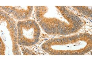 Immunohistochemistry of paraffin-embedded Human colon cancer using AKR1B1 Polyclonal Antibody at dilution of 1:30 (AKR1B1 Antikörper)