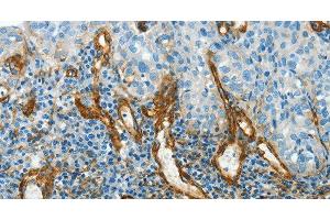 Immunohistochemistry of paraffin-embedded Human cervical cancer using CAV1 Polyclonal Antibody at dilution of 1:40 (Caveolin-1 Antikörper)