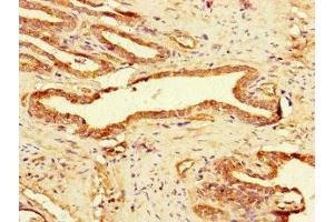 Immunohistochemistry of paraffin-embedded human prostate cancer using ABIN7158768 at dilution of 1:100 (GAA Antikörper  (AA 601-952))