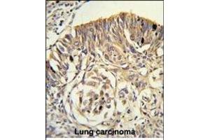 Formalin-fixed and paraffin-embedded human lung carcinoma reacted with PLTP Antibody (C-term), which was peroxidase-conjugated to the secondary antibody, followed by DAB staining.