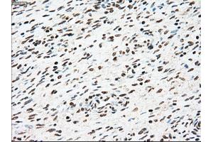 Immunohistochemical staining of paraffin-embedded Adenocarcinoma of colon tissue using anti-SSBmouse monoclonal antibody. (SSB Antikörper)