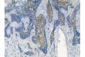 ABIN7093817 and ABIN7097860 at 1/100 staining human breast carcinoma by IHC-P. (CXCL2 Antikörper  (C-Term))