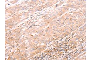 The image on the left is immunohistochemistry of paraffin-embedded Human esophagus cancer tissue using ABIN7189783(ALPPL2 Antibody) at dilution 1/20, on the right is treated with synthetic peptide. (ALPPL2 Antikörper)