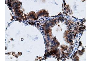 Immunohistochemical staining of paraffin-embedded Adenocarcinoma of Human breast tissue using anti-KHK mouse monoclonal antibody. (Ketohexokinase Antikörper)