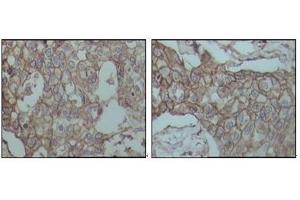 Immunohistochemical analysis of paraffin-embedded human breast carcinoma tissues, showing membrane localization with DAB staining using CD44 antibody. (CD44 Antikörper)