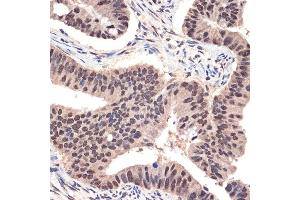 Immunohistochemistry of paraffin-embedded human colon carcinoma using EHMT2 Rabbit mAb (ABIN7265616) at dilution of 1:100 (40x lens). (EHMT2 Antikörper)