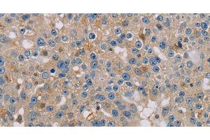 Immunohistochemistry of paraffin-embedded Human breast cancer using CLIC1 Polyclonal Antibody at dilution of 1:30