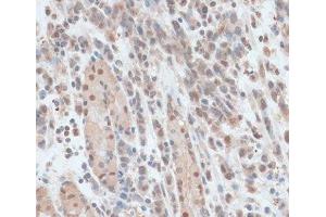 Immunohistochemistry of paraffin-embedded Human gastric cancer using ZNF562 Polyclonal Antibody at dilution of 1:100 (40x lens). (ZNF562 Antikörper)