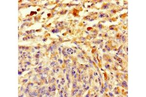 Immunohistochemistry of paraffin-embedded human melanoma using ABIN7148108 at dilution of 1:100 (C12ORF68 Antikörper  (AA 1-194))