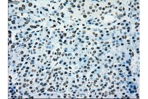 Immunohistochemical staining of paraffin-embedded Adenocarcinoma of colon tissue using anti-SILV mouse monoclonal antibody. (Melanoma gp100 Antikörper)