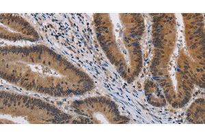 Immunohistochemistry of paraffin-embedded Human colon cancer using KCNG4 Polyclonal Antibody at dilution of 1:40 (KCNG4 Antikörper)
