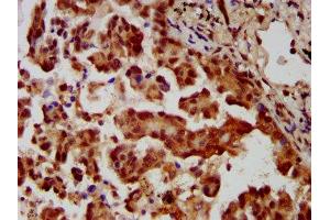 IHC image of ABIN7159000 diluted at 1:400 and staining in paraffin-embedded human lung cancer performed on a Leica BondTM system. (MBIP Antikörper  (AA 91-241))