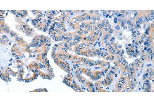 Immunohistochemistry of paraffin-embedded Human thyroid cancer using AMDHD2 Polyclonal Antibody at dilution of 1:40 (AMDHD2 Antikörper)