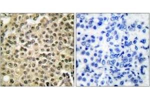 Immunohistochemistry analysis of paraffin-embedded human breast carcinoma tissue, using RAN Antibody. (RAN Antikörper  (AA 167-216))