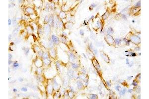 IHC-P: beta Defensin 1 antibody testing of lung cancer tissue (beta Defensin 1 Antikörper  (C-Term))