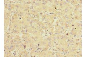 Immunohistochemistry of paraffin-embedded human liver cancer using ABIN7152170 at dilution of 1:100 (EIF3K Antikörper  (AA 1-218))