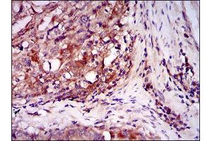 Immunohistochemical analysis of paraffin-embedded esophageal cancer tissues using ILK mouse mAb with DAB staining. (ILK Antikörper  (AA 97-244))