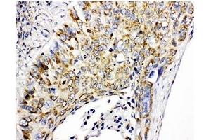 IHC-P: Prohibitin antibody testing of human lung cancer tissue (Prohibitin Antikörper  (C-Term))