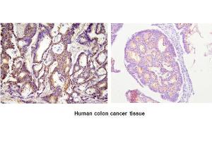 Paraffin embedded sections of human colon cancer tissue were incubated with anti-human ACOT11 (1:100) for 2 hours at room temperature. (ACOT11 Antikörper)