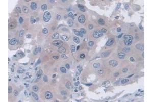 IHC-P analysis of Human Breast cancer Tissue, with DAB staining. (FAM3B Antikörper  (AA 30-187))