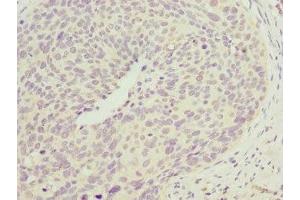 Immunohistochemistry of paraffin-embedded human cervical cancer using ABIN7147492 at dilution of 1:100 (CCM2 Antikörper  (AA 1-300))