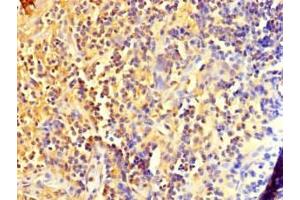 Immunohistochemistry of paraffin-embedded human bladder cancer using ABIN7150017 at dilution of 1:100 (DIS3L2 Antikörper  (AA 201-400))