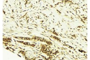 ABIN6269171 at 1/100 staining Human breast cancer tissue by IHC-P. (JunD Antikörper)