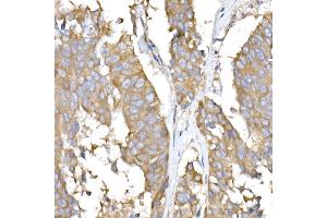 Immunohistochemistry of paraffin-embedded human lung cancer using USO1 Rabbit mAb (ABIN7271234) at dilution of 1:25 (40x lens). (USO1 Antikörper)
