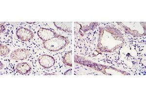 Immunohistochemical analysis of paraffin-embedded gastric cancer tissues (left) and lung cancer tissues (right) using CDH1 antibody with DAB staining.