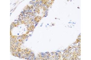 Immunohistochemistry of paraffin-embedded Human colon carcinoma using ZAK Polyclonal Antibody at dilution of 1:100 (40x lens). (ZAK Antikörper)