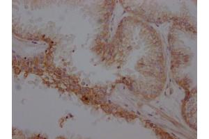 IHC image of ABIN7127366 diluted at 1:100 and staining in paraffin-embedded human prostate cancer performed on a Leica BondTM system.