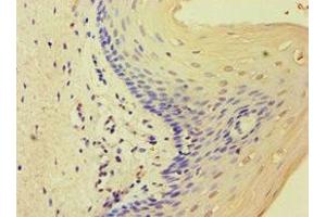 Immunohistochemistry of paraffin-embedded human cervical cancer using ABIN7159821 at dilution of 1:100 (MCMBP Antikörper  (AA 1-240))