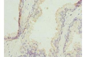 Immunohistochemistry of paraffin-embedded human prostate cancer using ABIN7176258 at dilution of 1:100 (ZNF35 Antikörper  (AA 233-532))