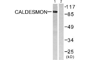 Immunohistochemistry analysis of paraffin-embedded human breast carcinoma tissue using Caldesmon (Ab-789) antibody. (Caldesmon Antikörper  (Ser789))