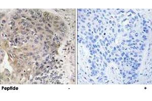 Immunohistochemistry analysis of paraffin-embedded human lung carcinoma tissue using AGBL3 polyclonal antibody . (AGBL3 Antikörper)