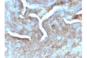 Formalin-fixed, paraffin-embedded human Prostate Carcinoma stained with Thymidine Phosphorylase Rabbit Recombinant Monoclonal (TYMP/2890R). (Rekombinanter Thymidine Phosphorylase Antikörper)