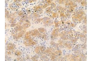 ABIN6263207 and ABIN6277295 at 1/100 staining human thymoma by IHC-P.