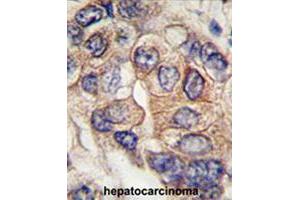 Formalin-fixed and paraffin-embedded human hepatocellular carcinoma reacted with PDGFRA polyclonal antibody  , which was peroxidase-conjugated to the secondary antibody, followed by DAB staining.