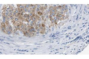 ABIN6274572 at 1/100 staining Human liver cancer tissue by IHC-P. (Serotonin Receptor 2B Antikörper  (Internal Region))