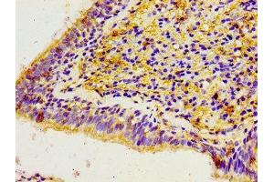 Immunohistochemistry of paraffin-embedded human lung cancer using ABIN7146450 at dilution of 1:100 (CACYBP Antikörper  (AA 2-228))