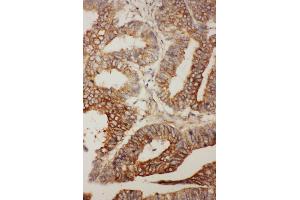 Anti- BCL2L2 antibody, IHC(P) IHC(P): Human Rectal Cancer Tissue (BCL2L2 Antikörper  (Middle Region))