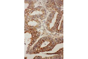 Anti- BCL2L2 antibody, IHC(P) IHC(P): Human Rectal Cancer Tissue