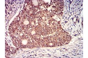 Immunohistochemical analysis of paraffin-embedded cervical cancer tissues using CD130 mouse mAb with DAB staining. (CD130/gp130 Antikörper  (AA 73-231))