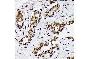 Immunohistochemistry of paraffin-embedded human breast cancer using ILF2 Rabbit mAb (ABIN7268007) at dilution of 1:100 (40x lens). (ILF2 Antikörper)