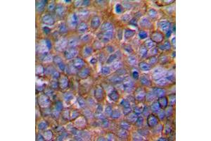 Immunohistochemical analysis of MKK1 staining in human prostate cancer formalin fixed paraffin embedded tissue section. (MEK1 Antikörper  (Center))