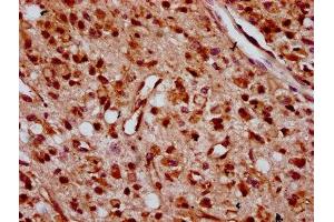 IHC image of ABIN7176263 diluted at 1:400 and staining in paraffin-embedded human glioma performed on a Leica BondTM system. (ZNF367 Antikörper  (AA 83-151))