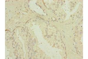 Immunohistochemistry of paraffin-embedded human prostate cancer using ABIN7159922 at dilution of 1:100 (MIPEP Antikörper  (AA 504-713))
