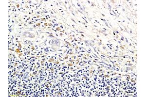 Formalin-fixed and paraffin embedded human colorectal cancer labeled with Anti-LI-cadherin Polyclonal Antibody, Unconjugated (ABIN732128) followed by conjugation to the secondary antibody and DAB staining (LI Cadherin Antikörper  (AA 101-200))