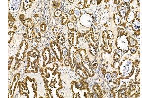 ABIN7095662 and ABIN7099724 at 1/100 staining human ovarian cancer by IHC-P. (USP4 Antikörper)
