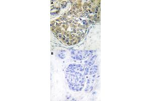Immunohistochemical staining (Formalin-fixed paraffin-embedded sections) of human breast cancer tissue with TNK2 (phospho Y284) polyclonal antibody  without blocking peptide (A) or preincubated with blocking peptide (B) under 1:50-1:100 dilution. (TNK2 Antikörper  (pTyr284))